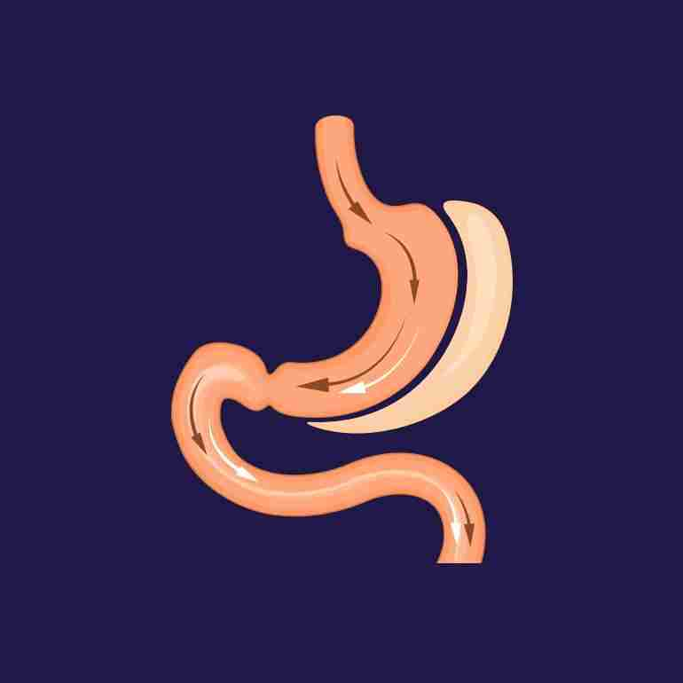 عملية تكميم المعدة