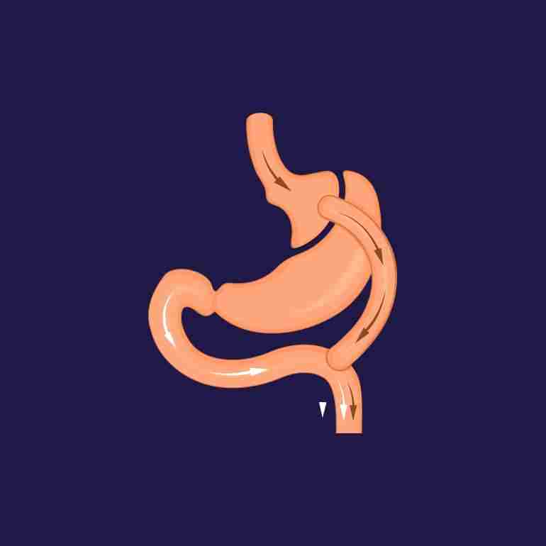 Gastric bypass