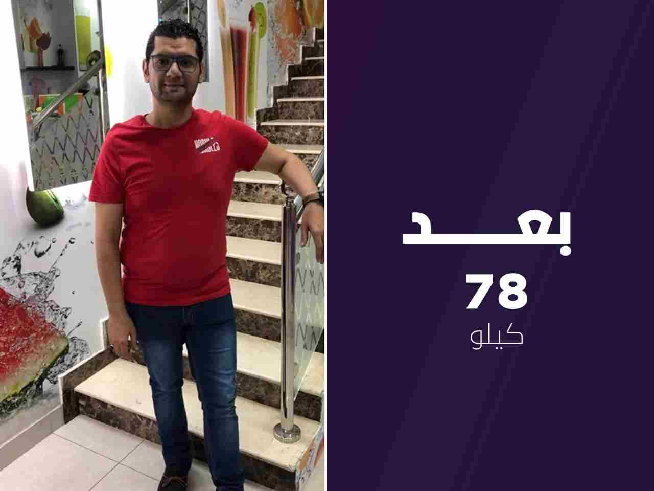 تكميم المعدة